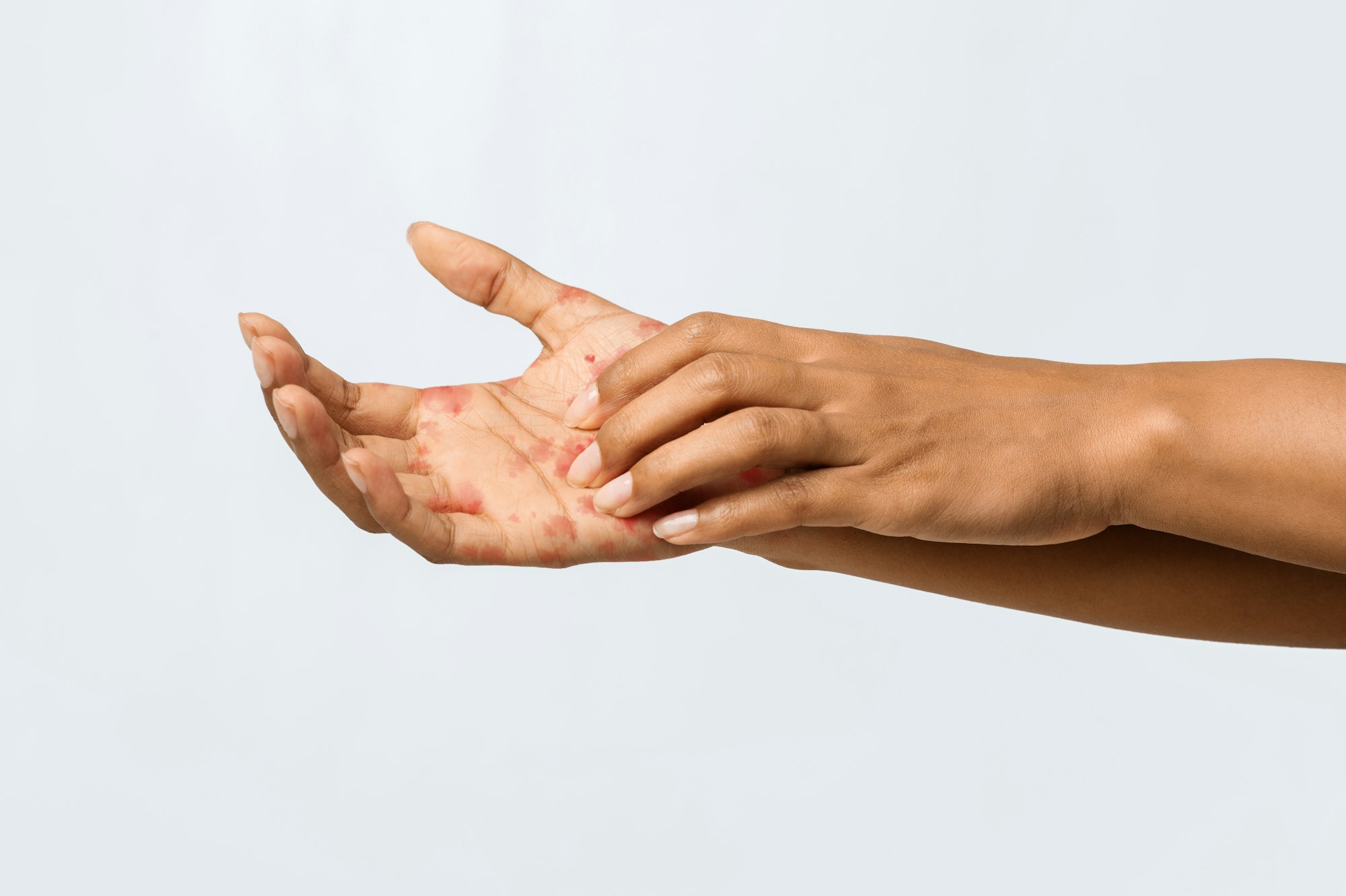 Afro woman having eczema on her palm