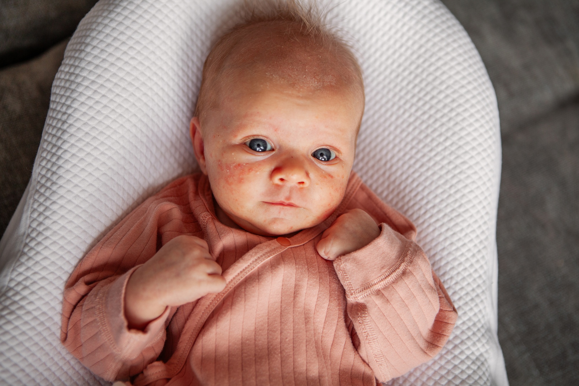 Close-up newborn baby face with neonatal acne, looking at camera, dressed in light pink clothing