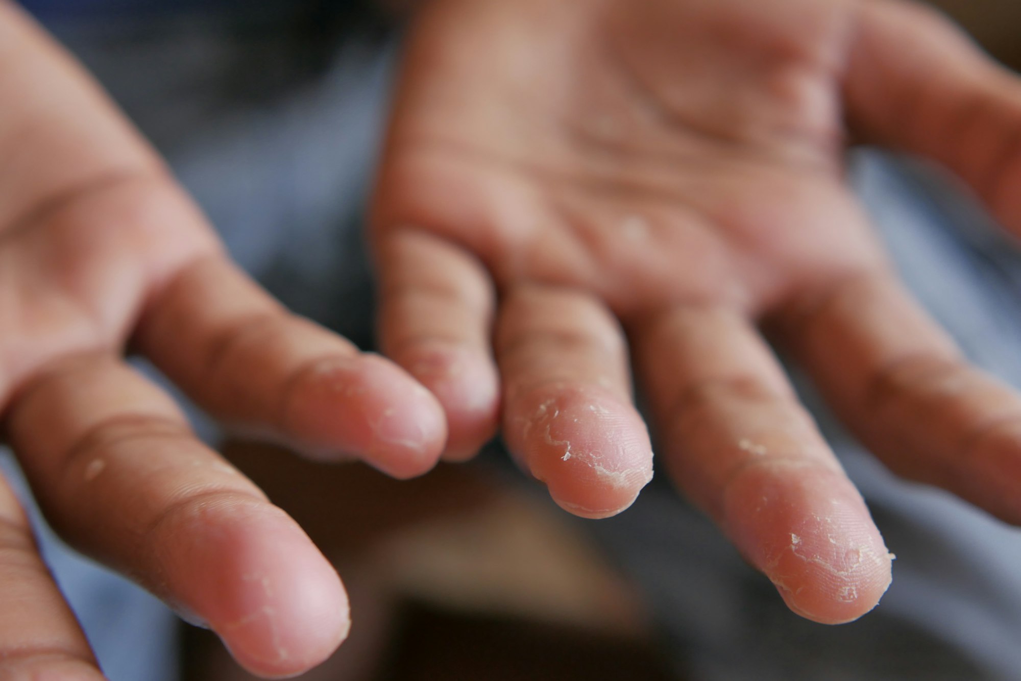 close up of Dry cracked skin of a men's hand