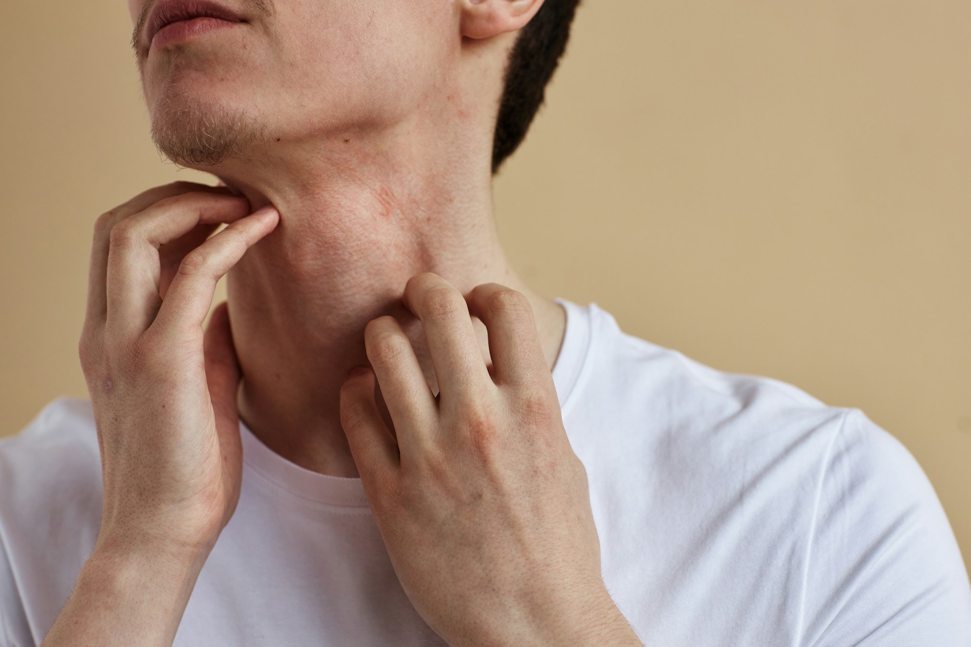 Close up of man scratching neck itch and allergies