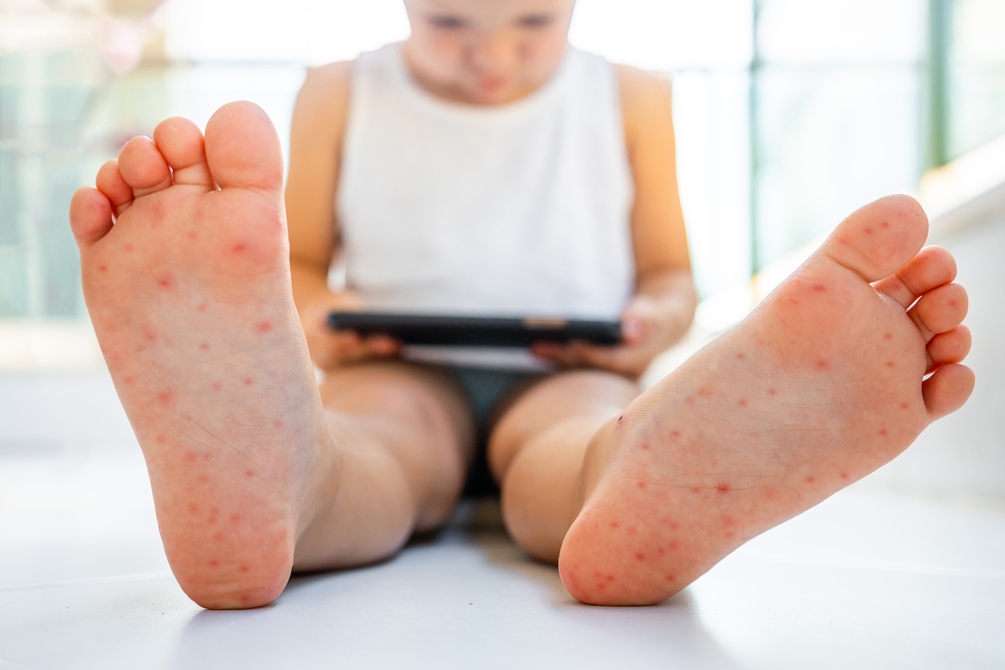 Enterovirus Leg - arm - mouth. Rash on the body of a child. Cocksackie virus.