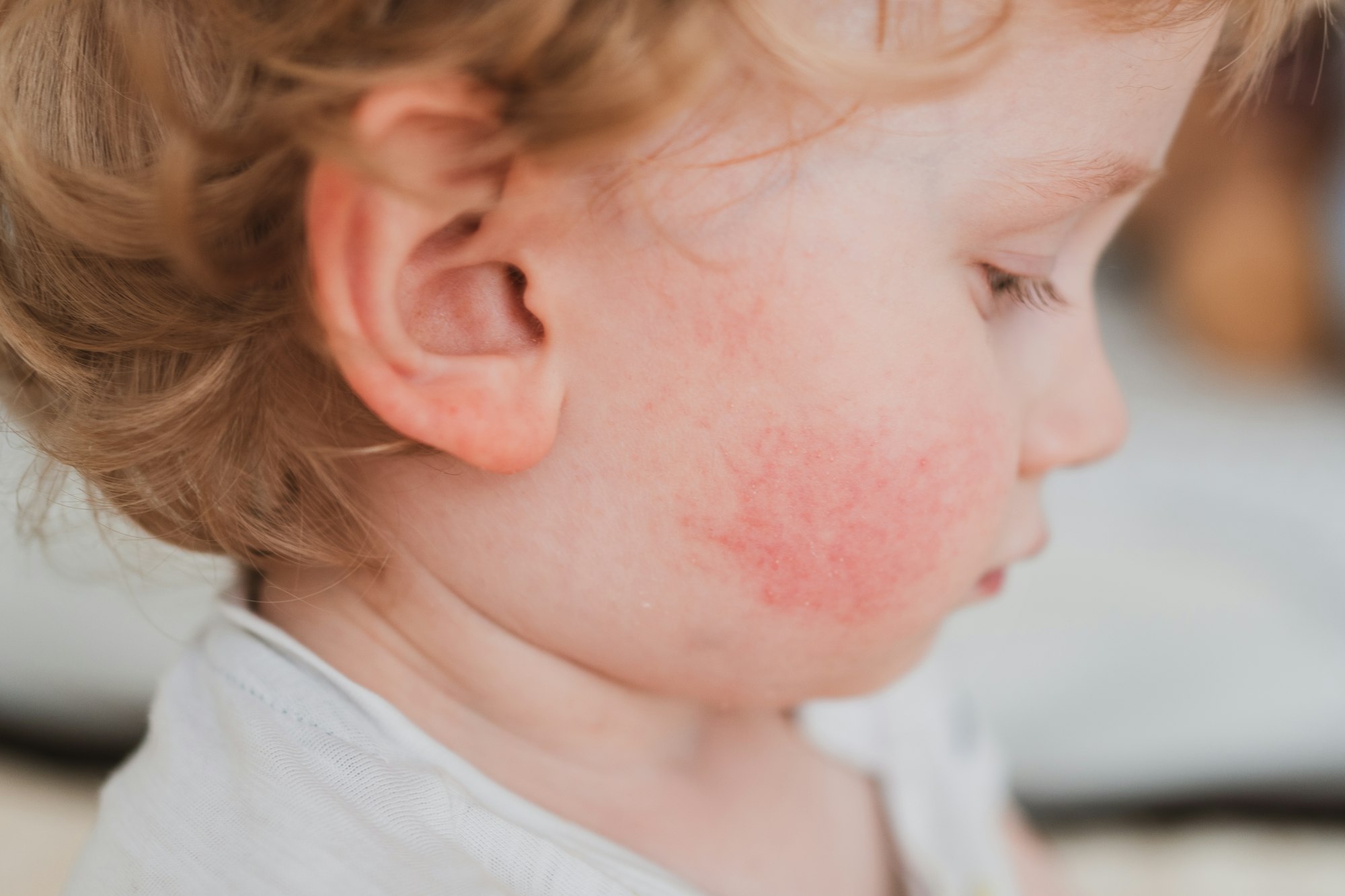 food allergies, eczema, or diathesis in a small child on the cheeks