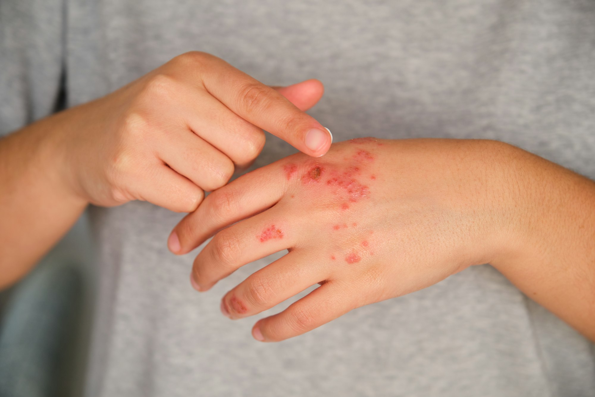 Patient hands applying ointment cream on eczema.