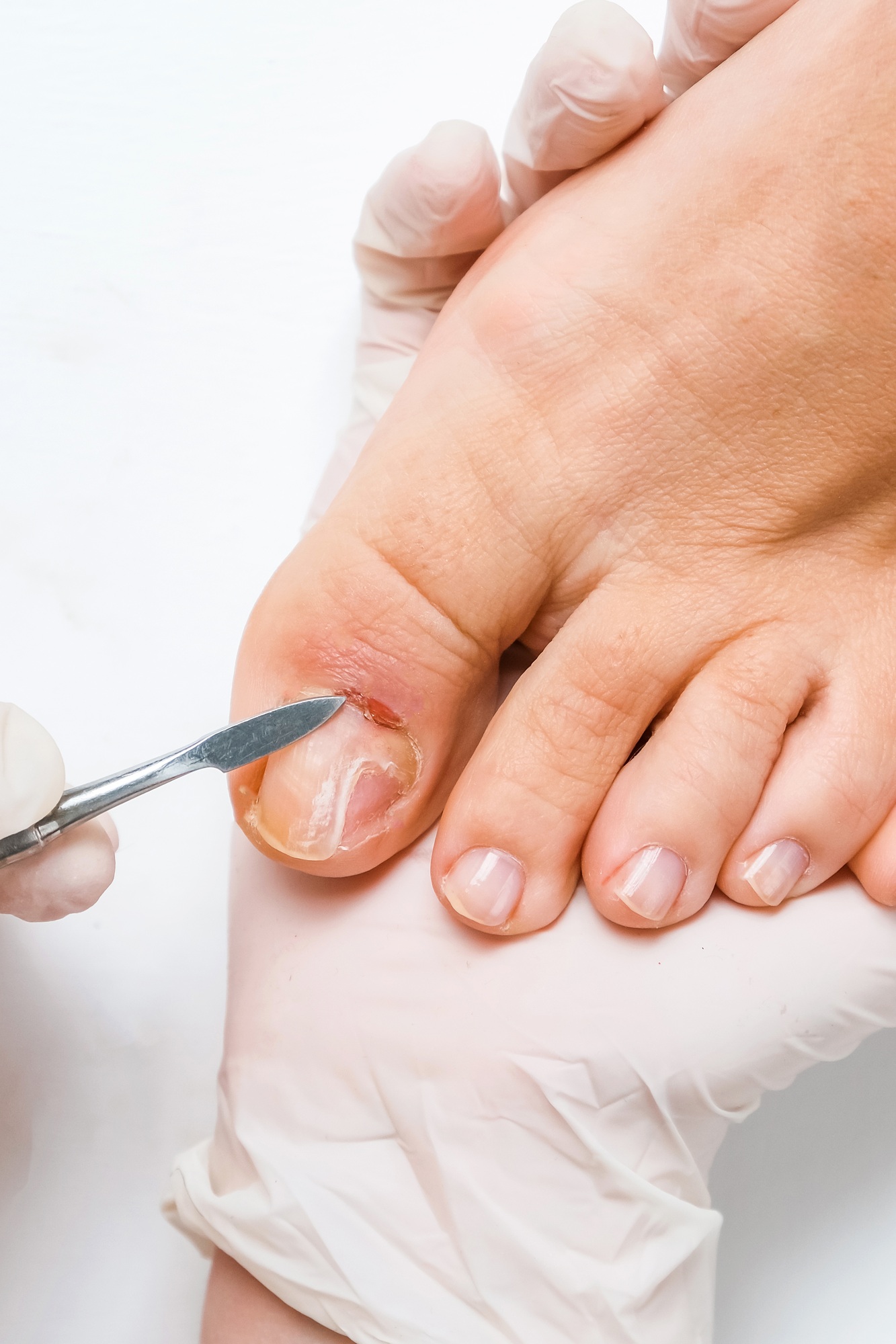 Pedicure, podologist. Patient on medical pedicure procedure, nail disease, cholesis detachment of th