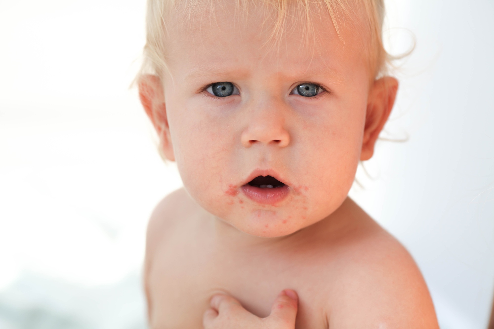 Portrait of a baby with a rash near the mouth. Enterovirus, allergy in a kid.