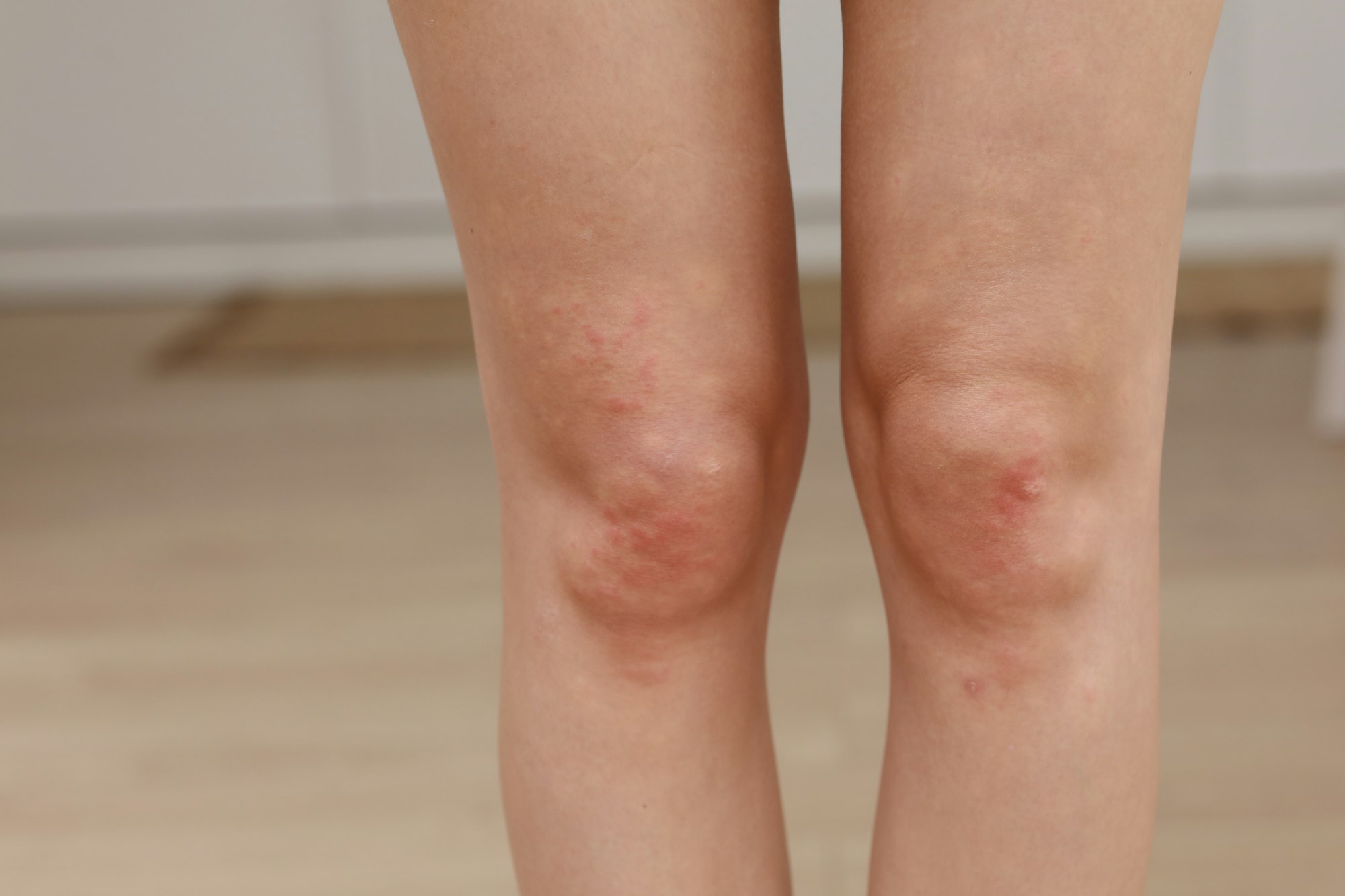 skin allergies, legs skin women. Closeup of red pustules on a knee, an allergic reaction caused