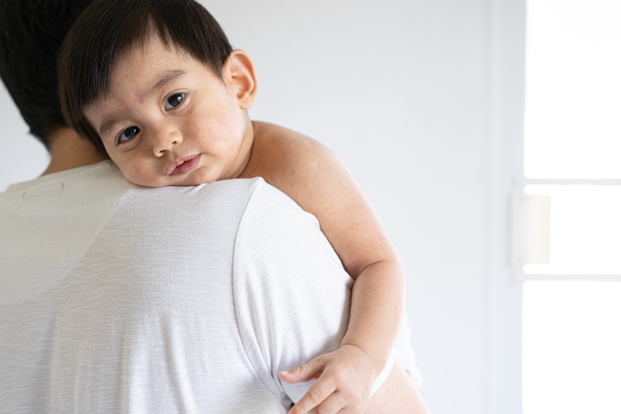 The parent is hugging a sickness asian little baby boy from viral infection skin rash.