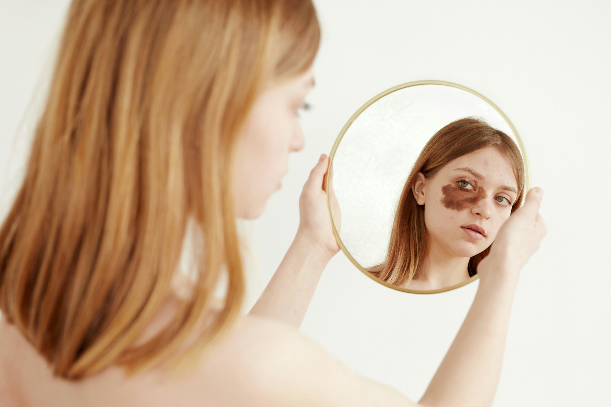 Woman with birthmark on face looking at mirror