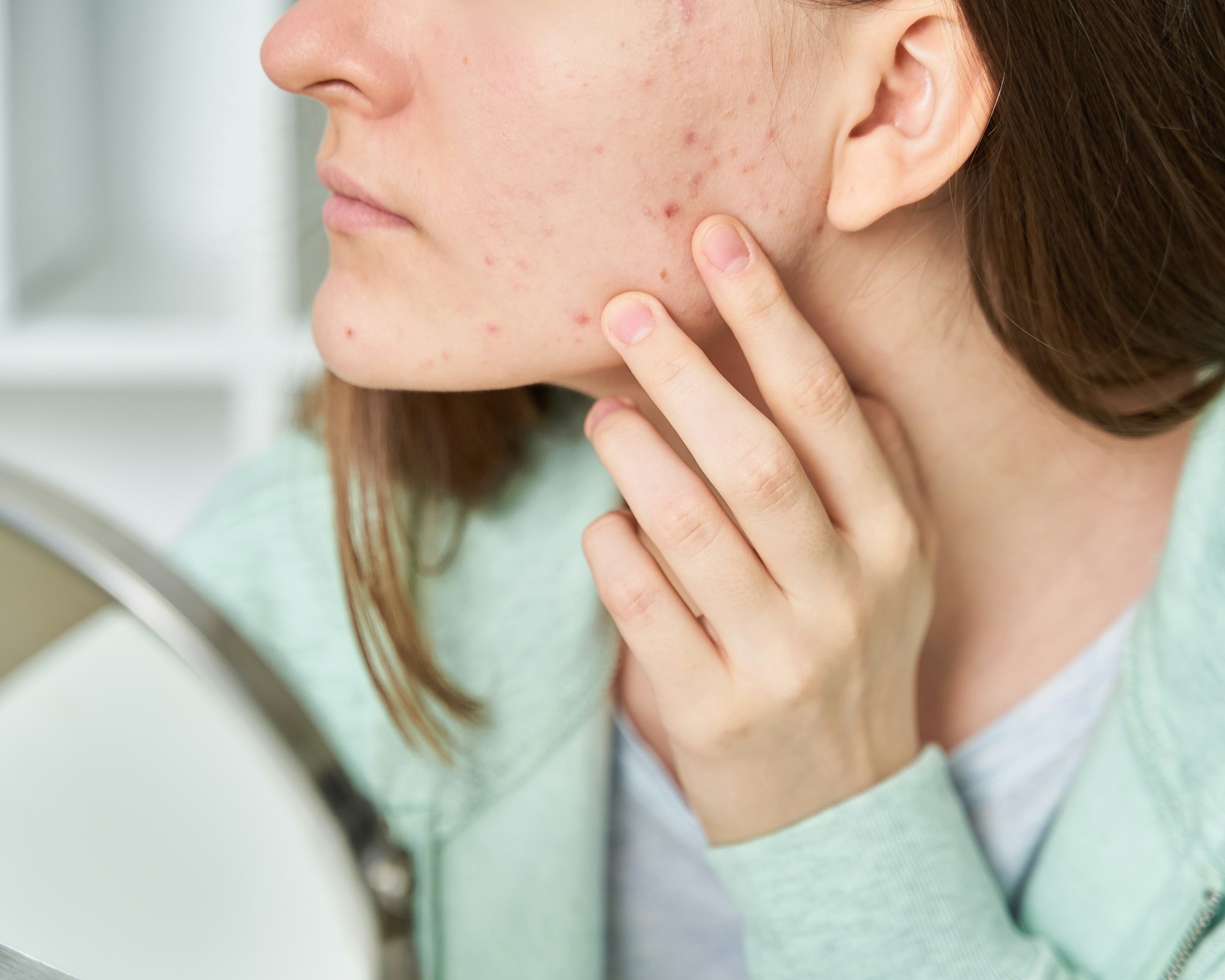 Young woman with problem skin looking at mirror and sees blackheads on skin