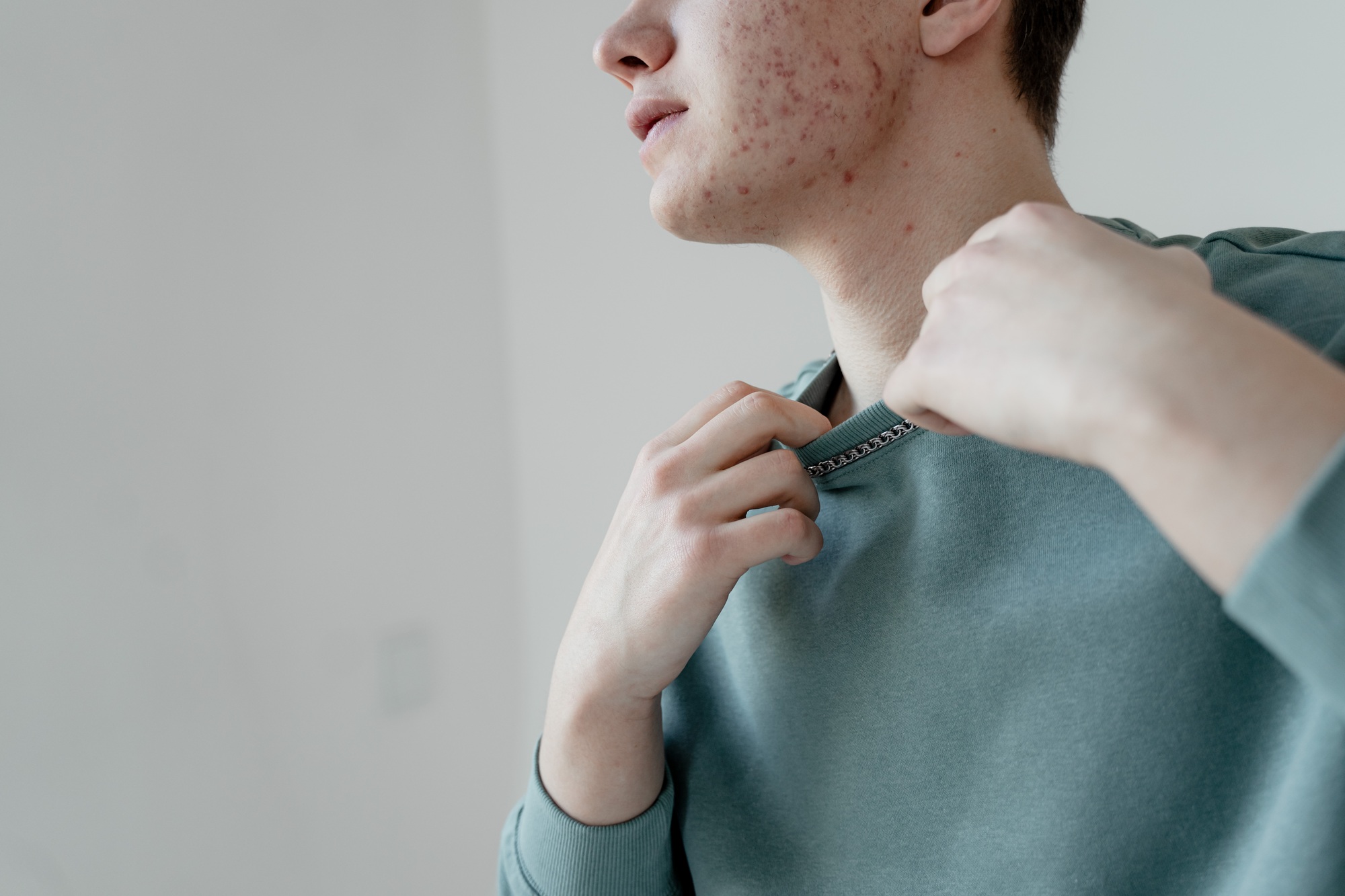 a guy in a turquoise sweater with problem skin on his face, acne, a teenager in transitional age