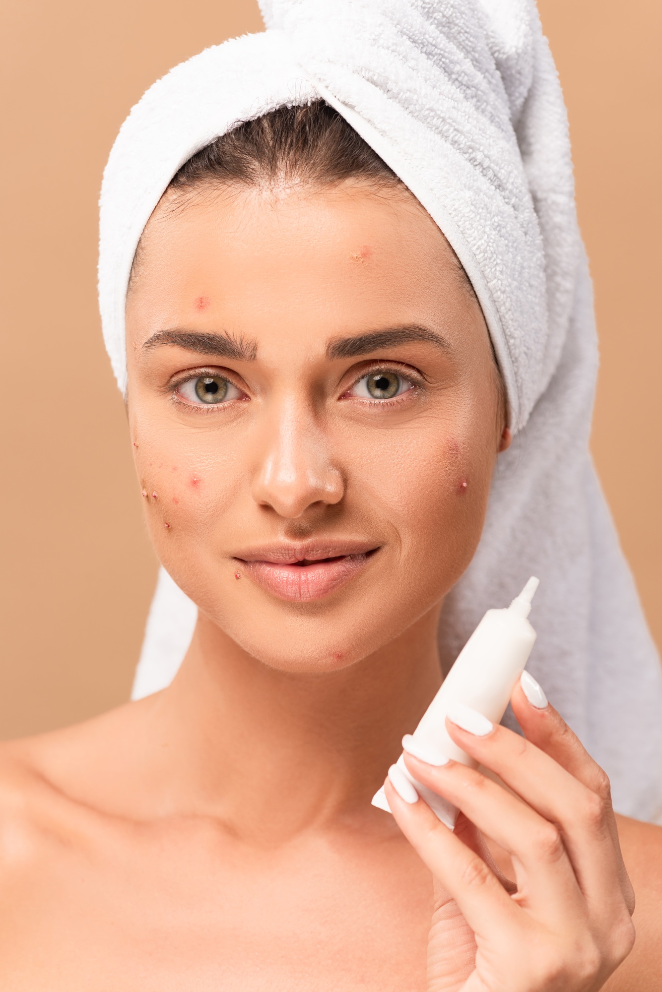 cheerful and naked girl with acne on face holding treatment cream isolated on beige