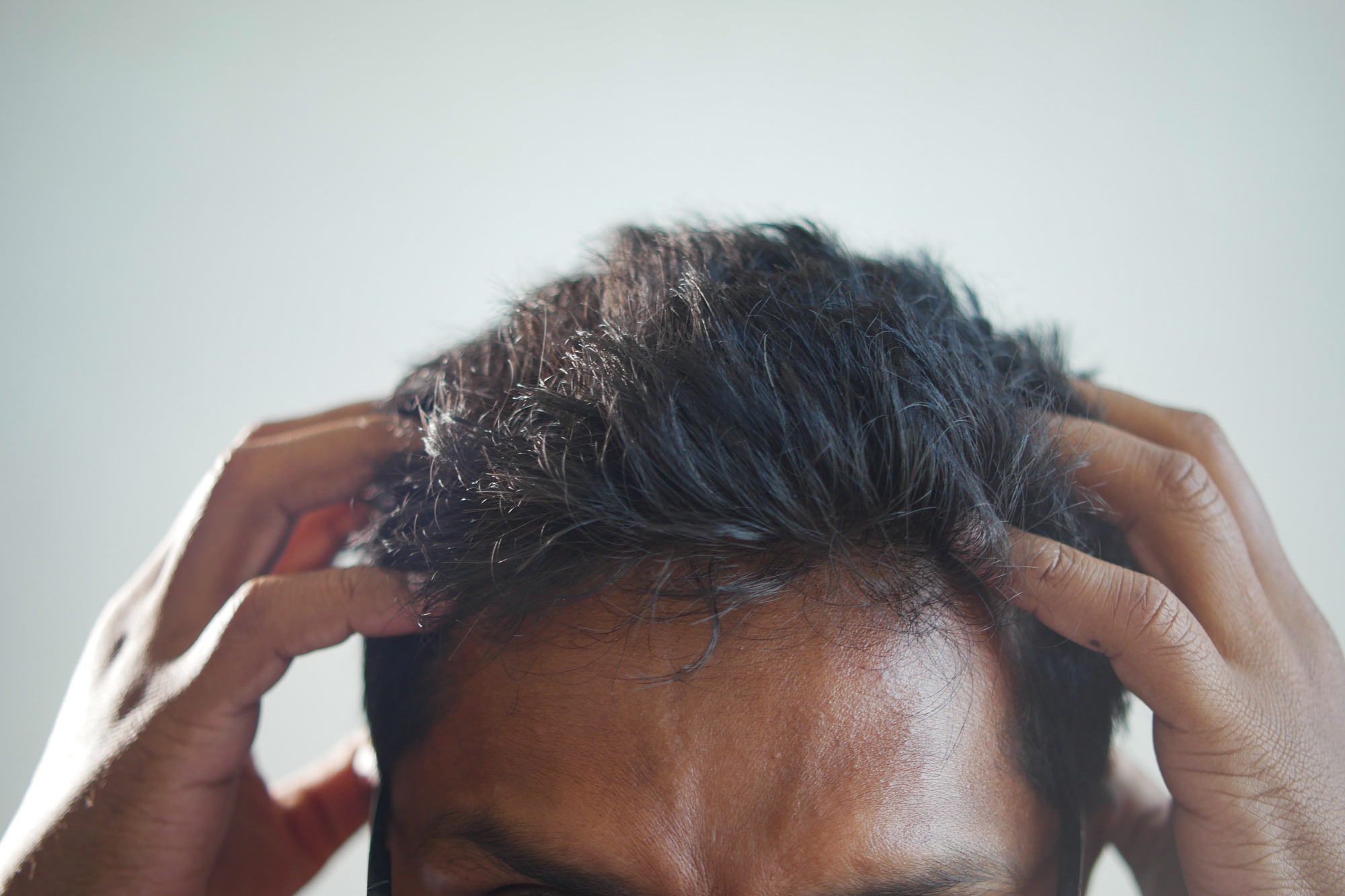 men with dandruff in his hair, closeup