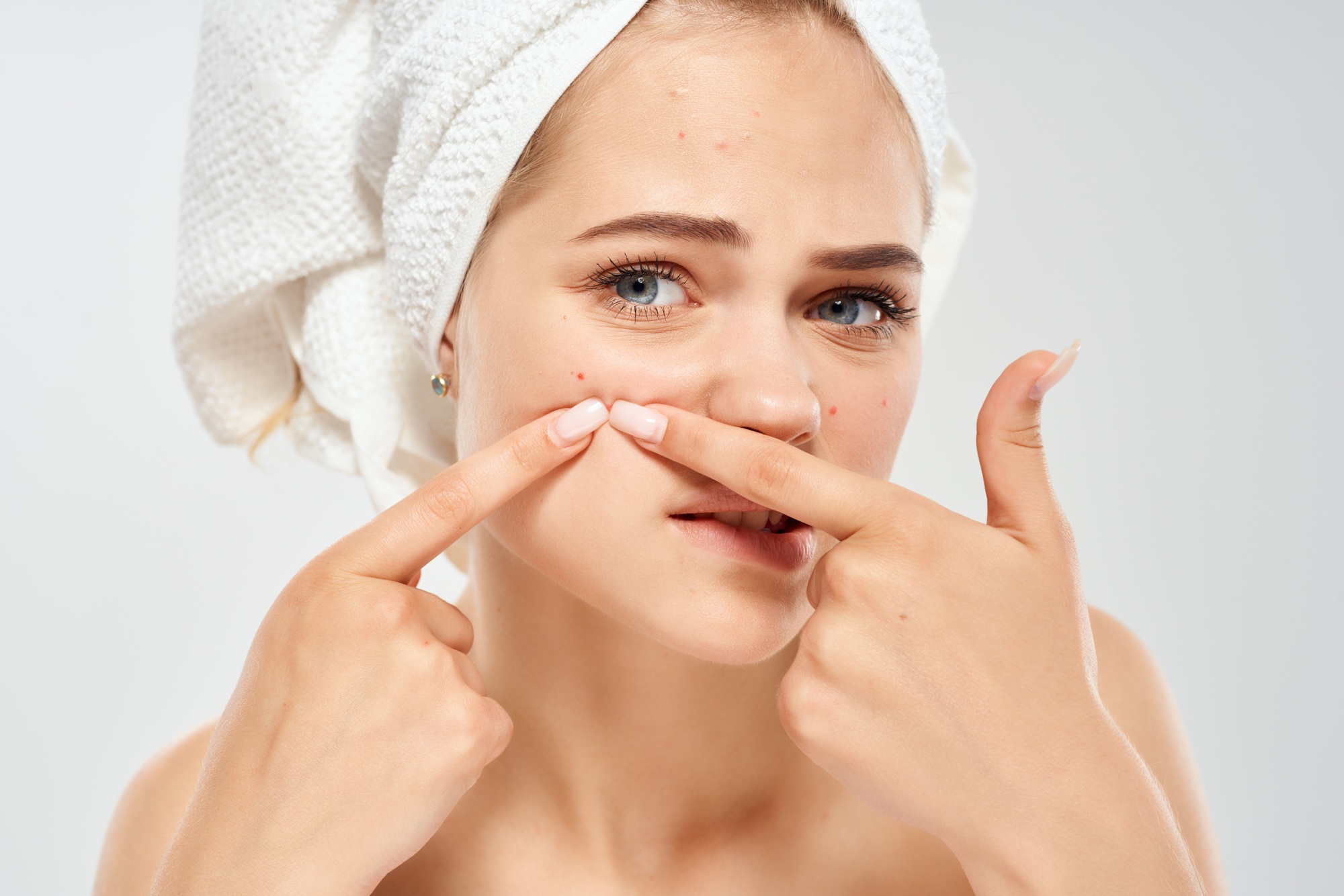 woman with bare shoulders with a towel on her head acne dermatology