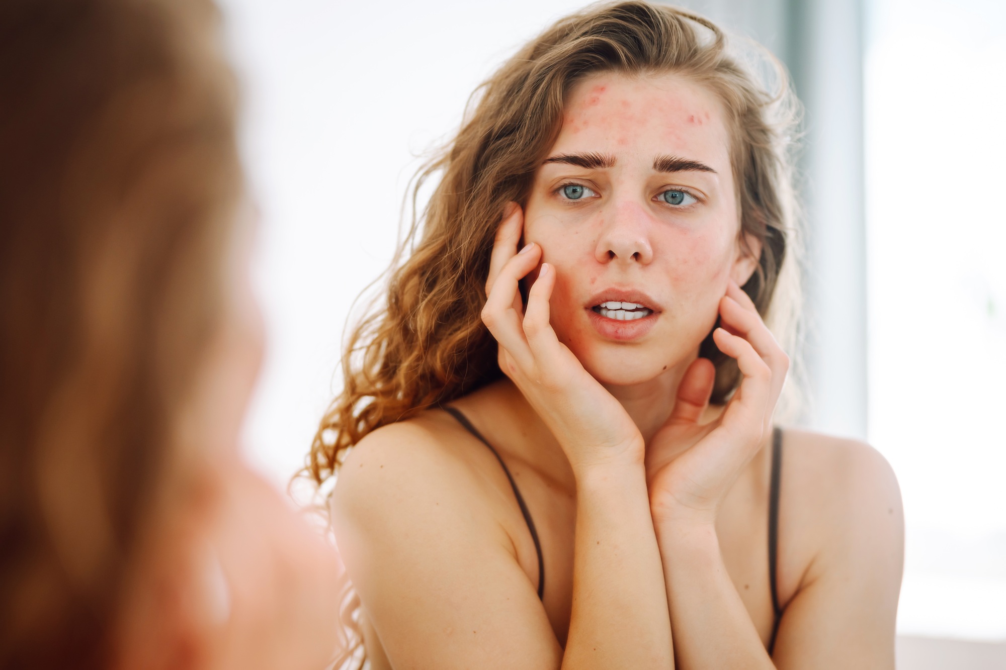 Young woman looks in mirror examining inflammation on her face. Acne skin. Medicine and cosmetology.