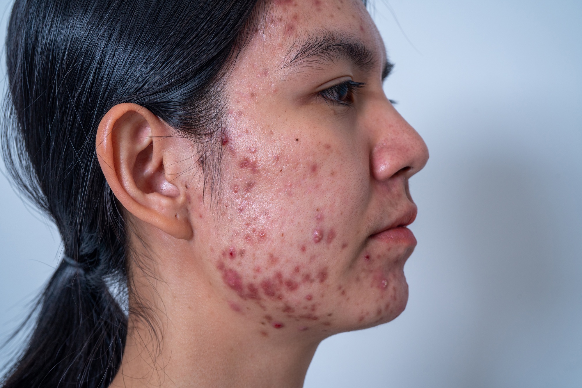 Acne on face because the disorders of sebaceous glands productions. Acne or a Cosmetic