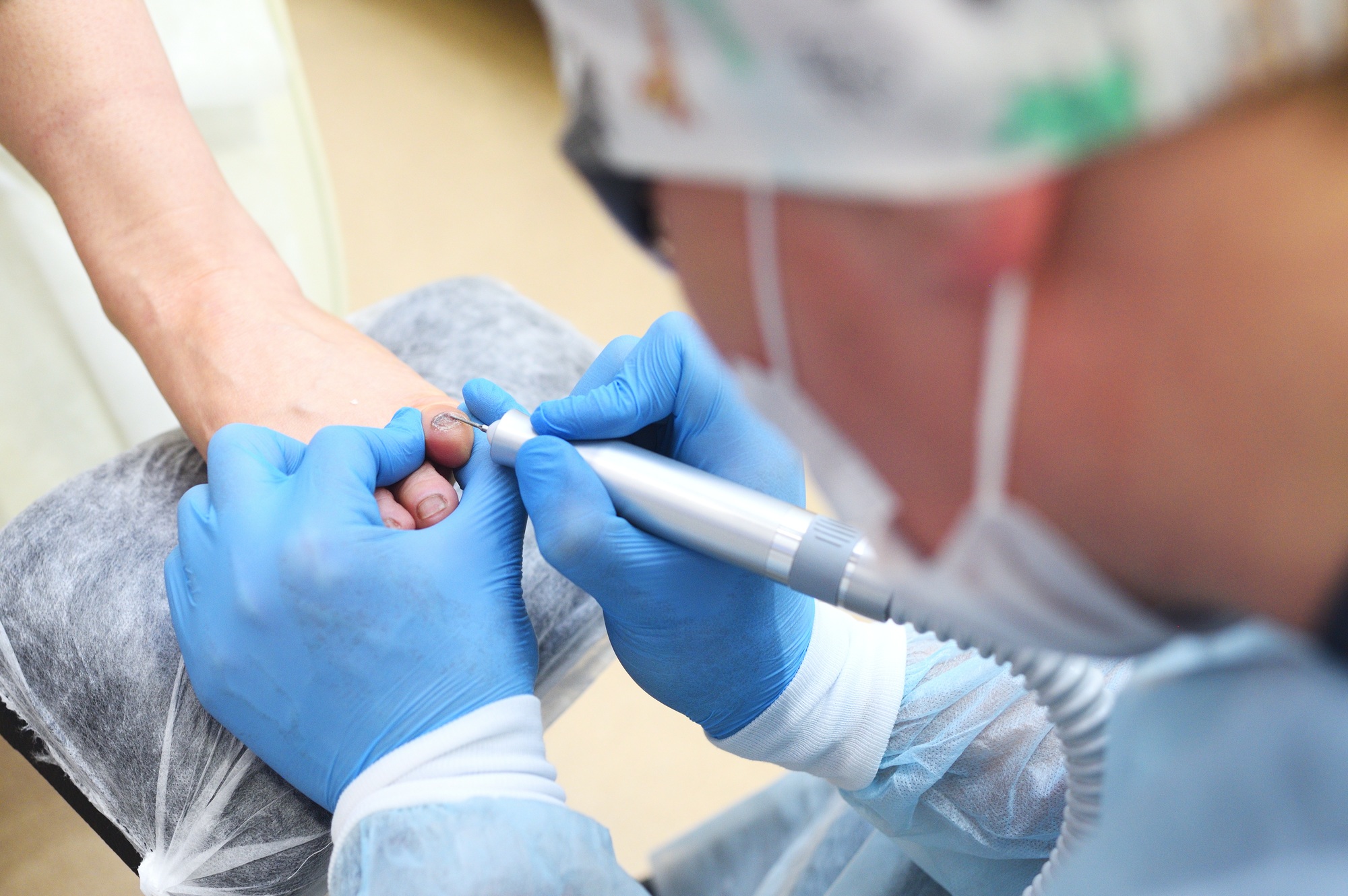 Hardware medical pedicure with a drill for nail files. Onychomycosis, treatment of nail fungus