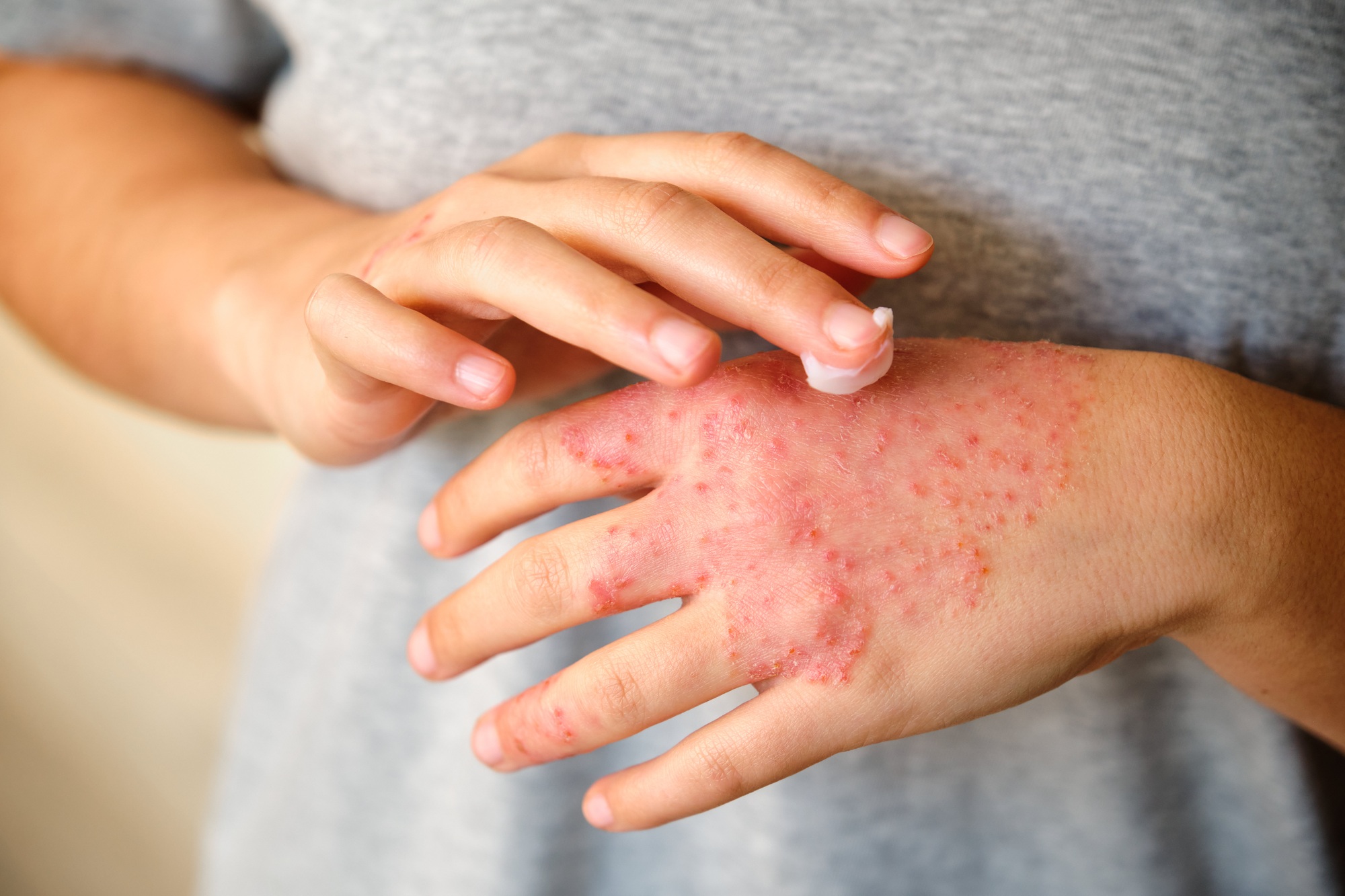 Woman applying ointment or moisturizing cream in the eczema, atopic dermatitis.