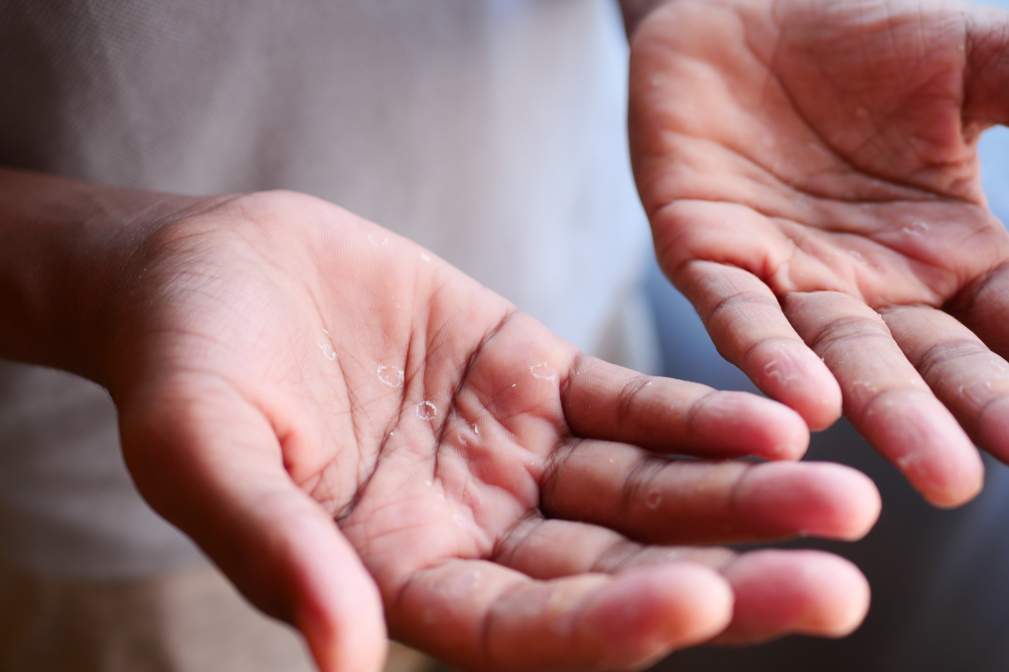 close up of Dry cracked skin of a men's hand