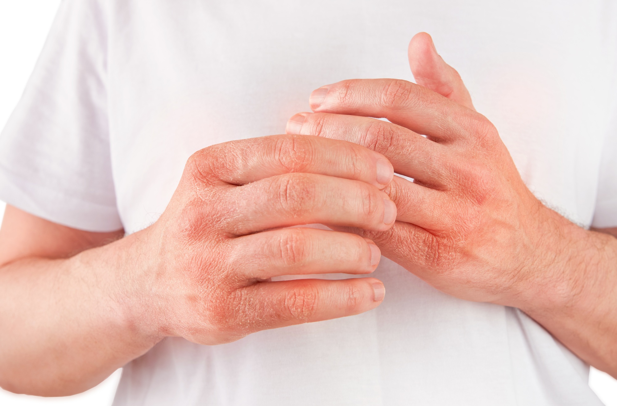 Man scratches or shows hands with dry, cracked skin on white backgrounds. Problem with many people -