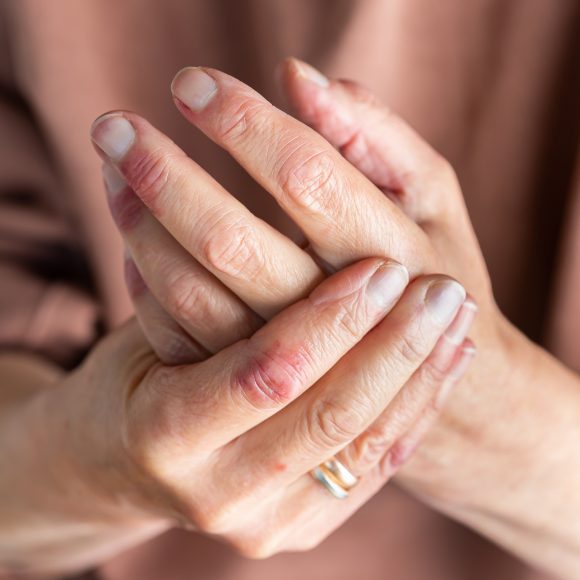 Woman hands with atopic dermatitis, eczema, allergy reaction on skin