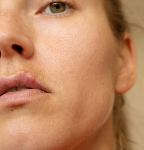 Woman’s face with a cold sore on her lip